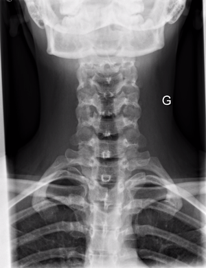 Radiographie colonne cervicale AP.png